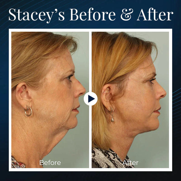 🎄HOT SALE🔥-Sleeping V-Face Beauty Device